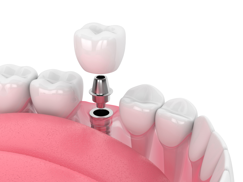 3d,Render,Of,Jaw,With,Dental,Implant,Isolated,Over,White