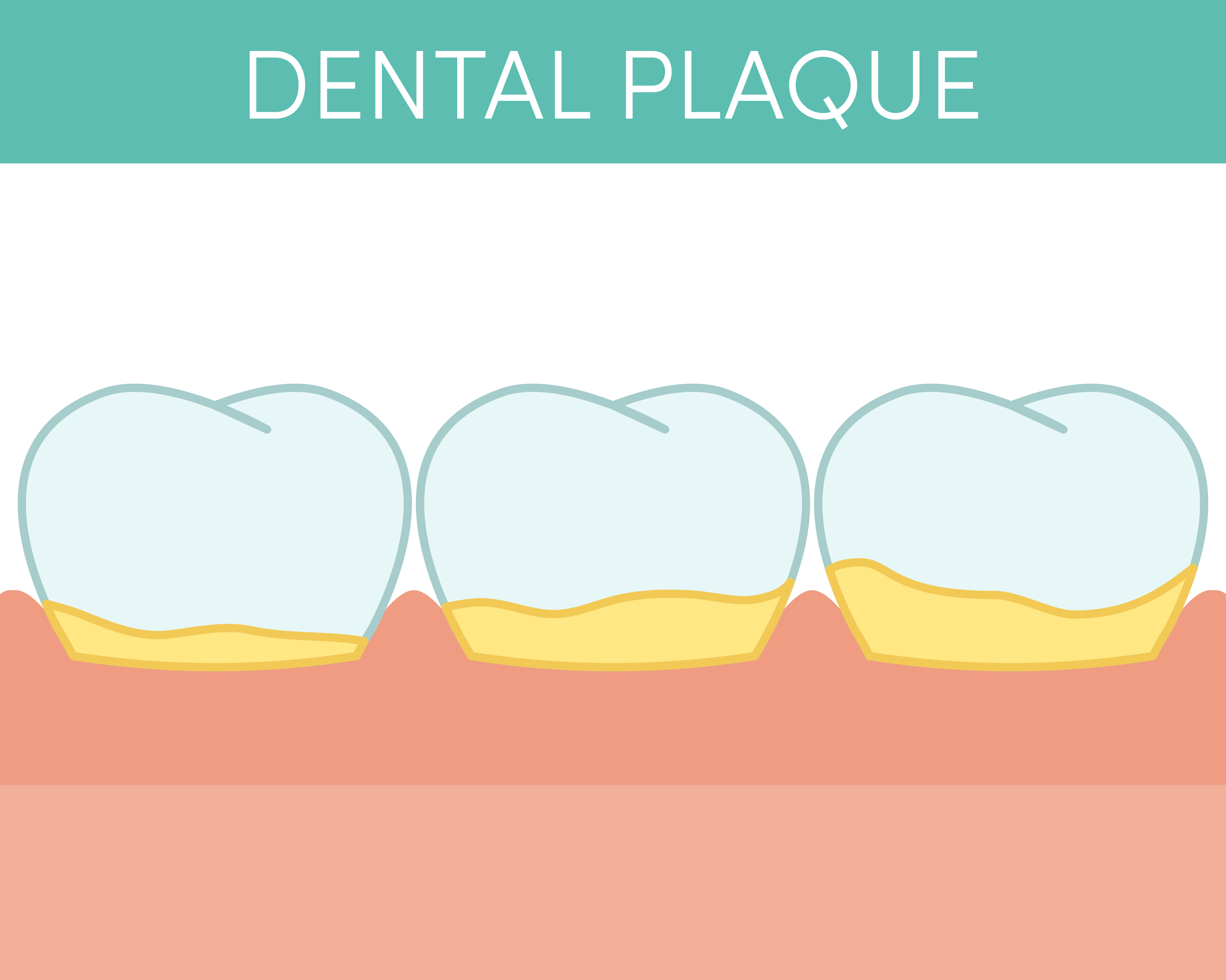 Illustration of plaque buildup on teeth