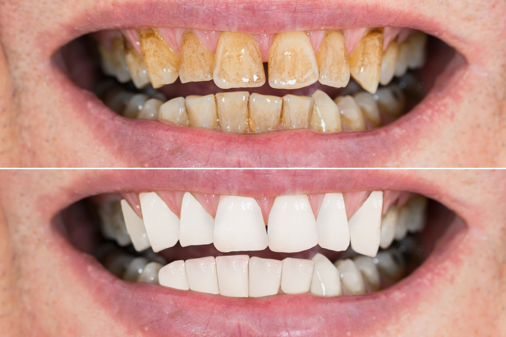 Before and after: A close-up comparison showcasing the remarkable results of teeth whitening in San Francisco